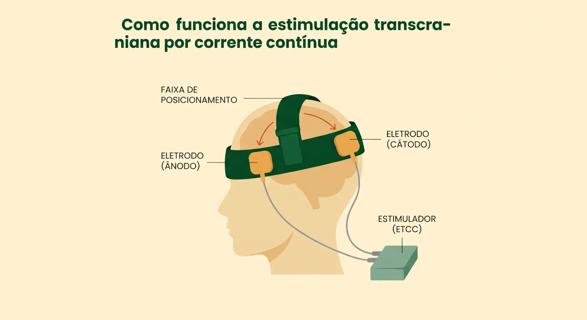 Ilustração explicando como funciona a estimulação transcraniana por corrente continua (ETCC), com um eletrodo ânodo e outro catodo posicionados na cabeça e um estimulador conectado por cabos.